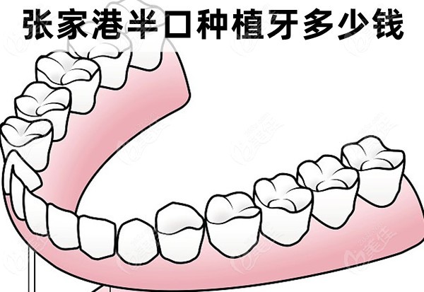 张家港半口种植牙多少钱