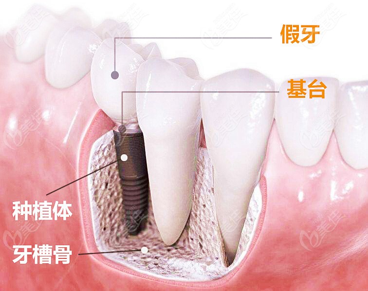 种植牙用骨粉有什么好处