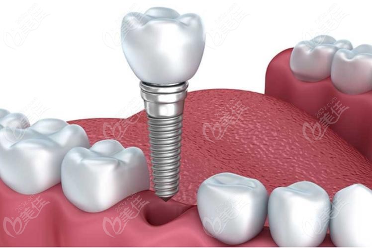种植牙结构示意