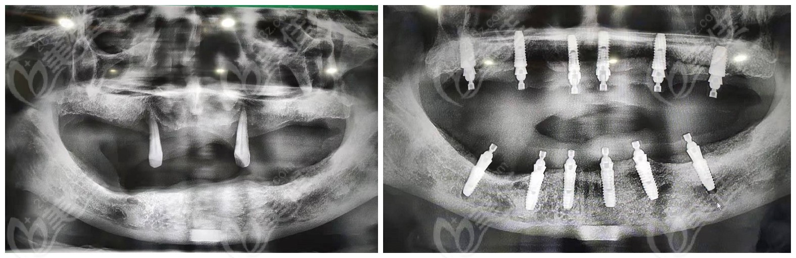全口allon6种植牙前后CT对比