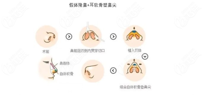 北京薛軼群做耳軟骨鼻綜合手術過程圖解