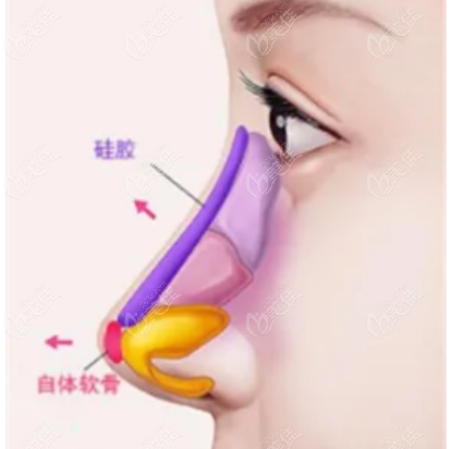 假体隆鼻手术