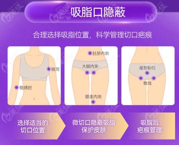 上海薇琳医院张怀军医生大腿吸脂技术优势