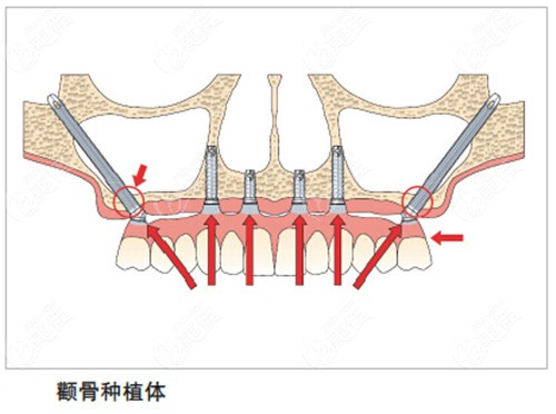 品壹口腔张冰大夫做种植牙收费不贵
