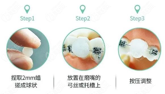 正畸保护蜡使用方法