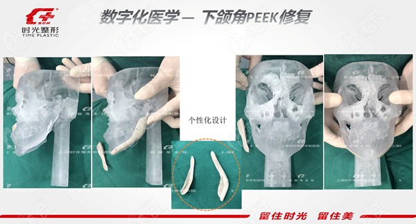 上海时光何晋龙医生peek人工骨修复下颌角照片