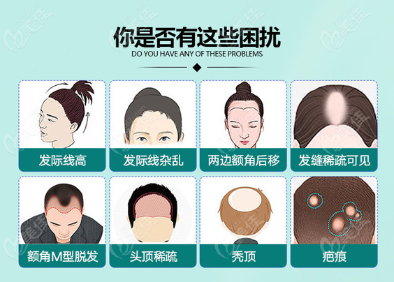 广州仁健植发可解决多种毛发问题
