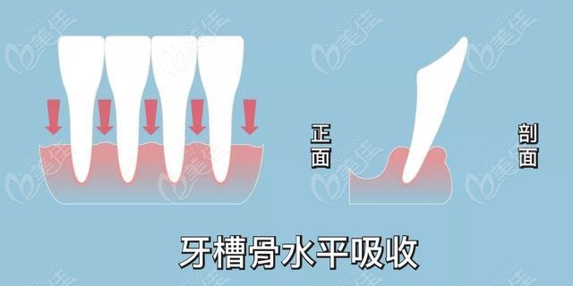 牙槽骨水平型吸收