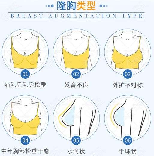 可以做假体隆胸的类型图