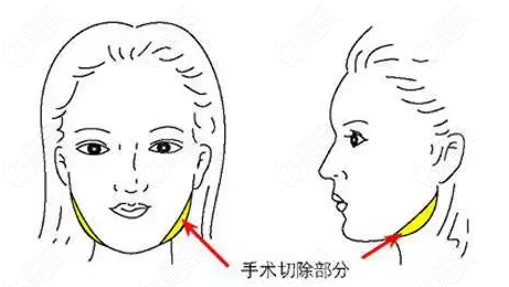 昆明磨骨手术好的医生——姜宇禄