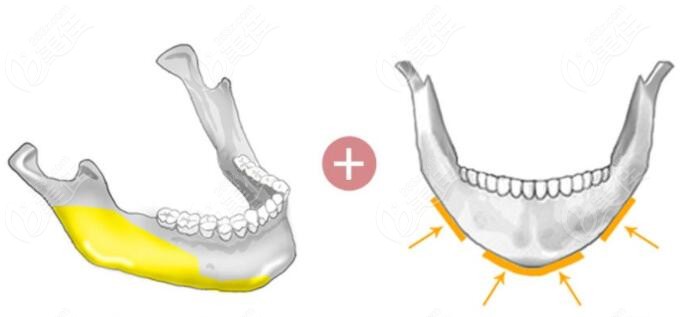 韩国菲斯莱茵整形做下颌角修复的原理图