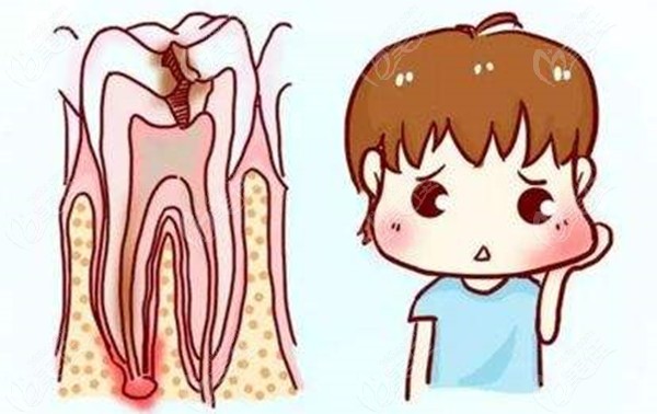 先回答乳牙根管治疗有必要吗?