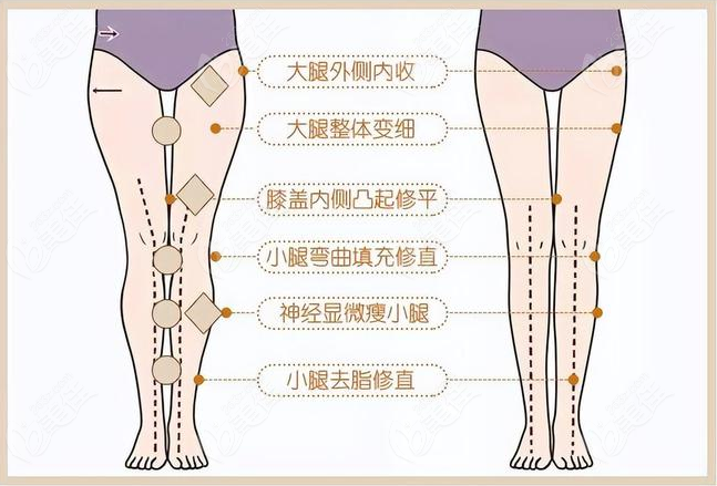 南京藝星能做難度較大的直腿術矯正o型腿