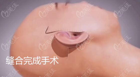 王志军医生做拉皮手术的示意图