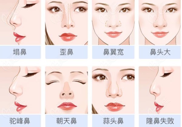 上海九慕鼻综合整形价格