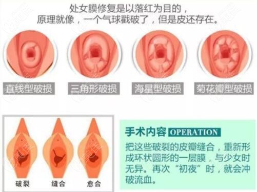 处女膜修复的原理手术过程