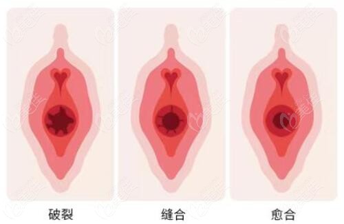 处女膜修复去哪做