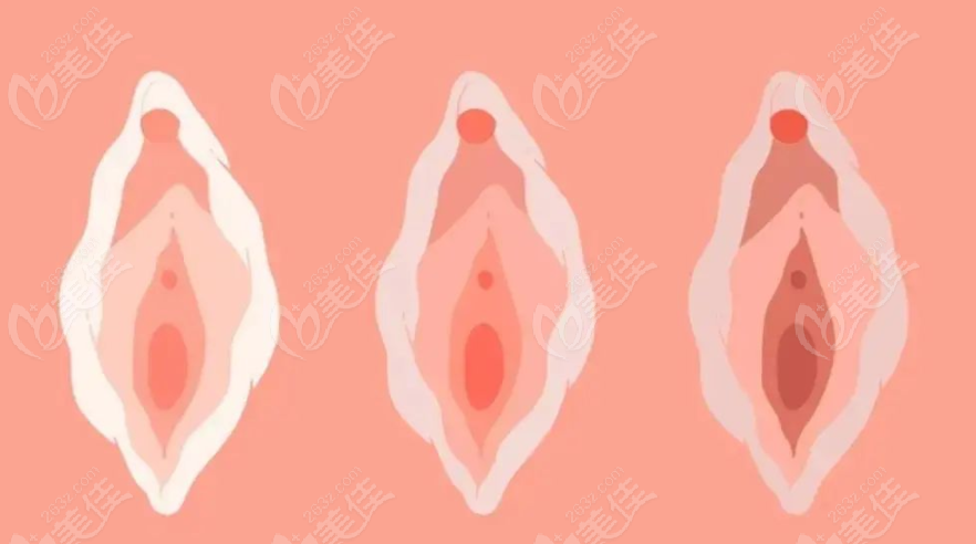 3D生物束带阴道紧缩手术