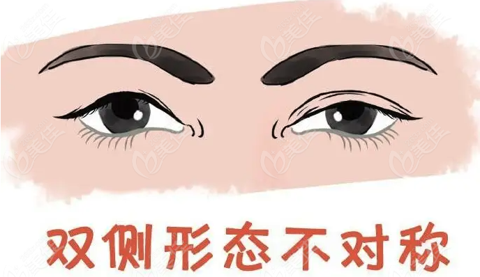 雙眼皮失敗鑒定標準