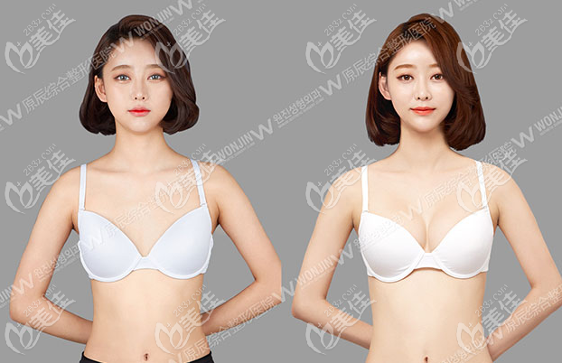 韩国原辰假体隆胸前后对比图