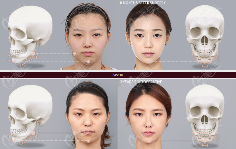 韩国DA李相雨下颌角整形+颧骨手术对比照片