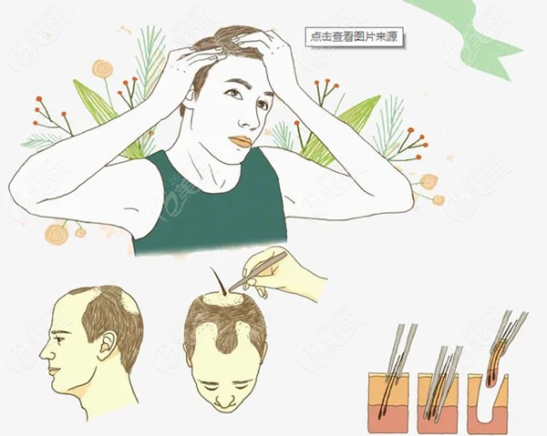植发价格为什么那么贵啊