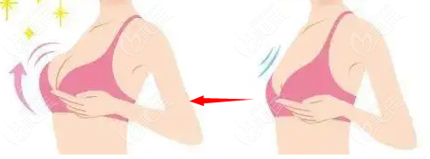 星熠假体240中凸术后图片@美佳网