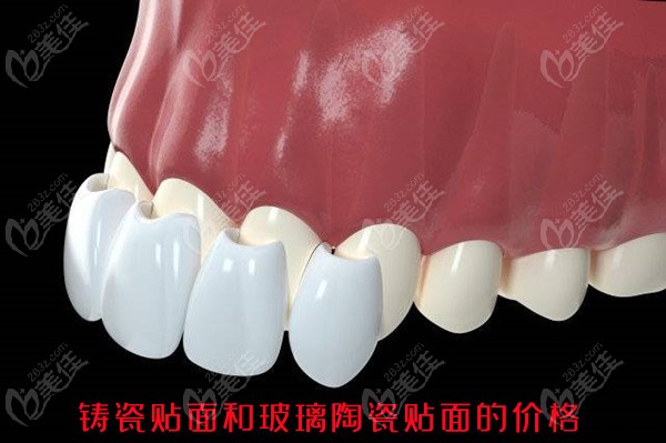 铸瓷贴面和玻璃陶瓷贴面的价格