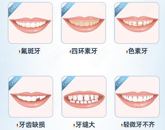 我做牙齿贴面5年后感受