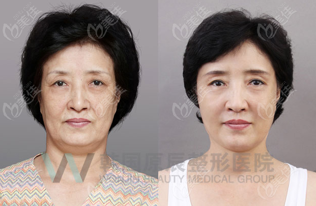 韩国原辰大拉皮手术实例照片