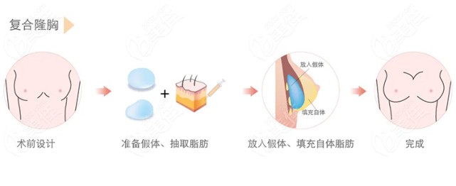 南京艺星潘峰做的BSK宫廷复合式隆胸技术