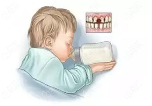 门牙奶瓶龋怎么治疗