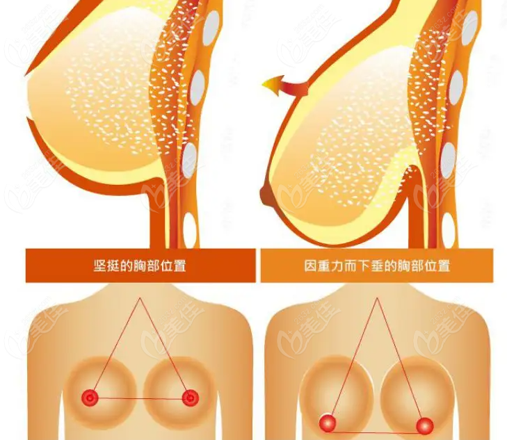 成都做乳房下垂矫正技术比较好的医生推荐