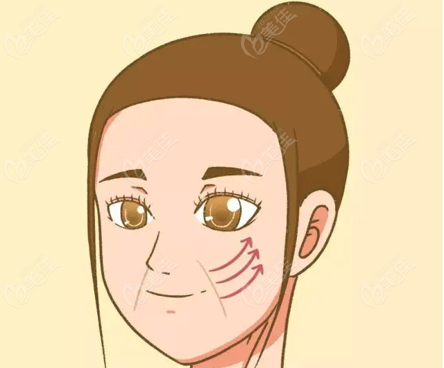 V美减龄面部提升怎么样