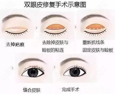 唐龍醫(yī)生雙眼皮修復(fù)技術(shù)圖