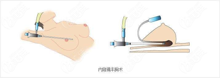 武汉内窥镜隆胸手术
