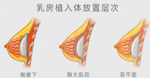 假体隆胸