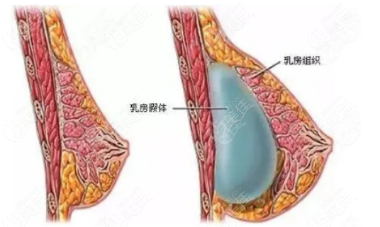假体隆胸