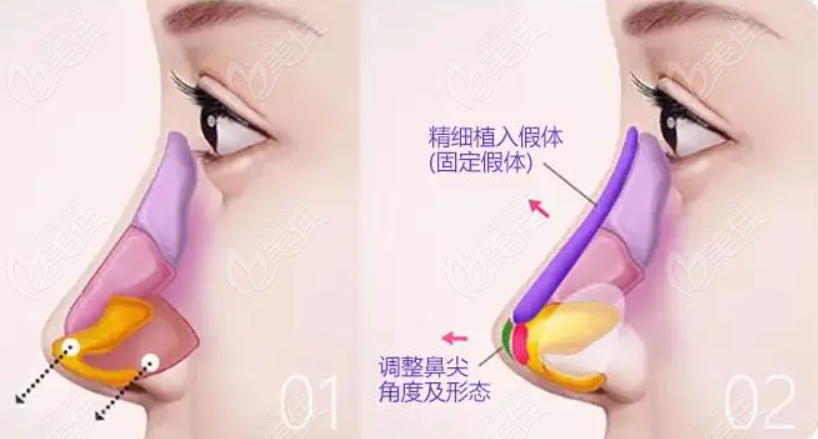 美仑美奂隆鼻手术图示