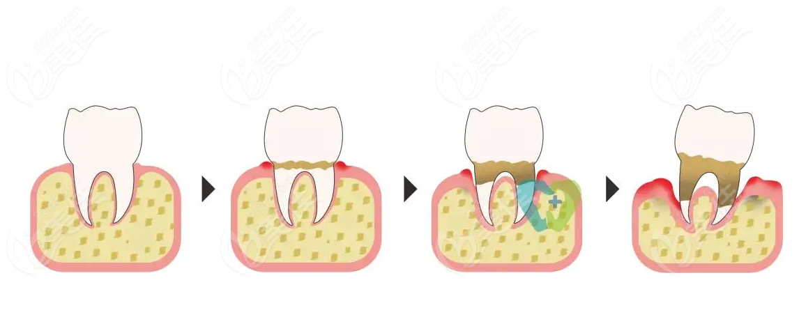 正畸导致牙槽骨吸收可以恢复吗