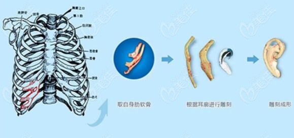 北京煤醫(yī)肋骨耳再造手術(shù)過程圖解