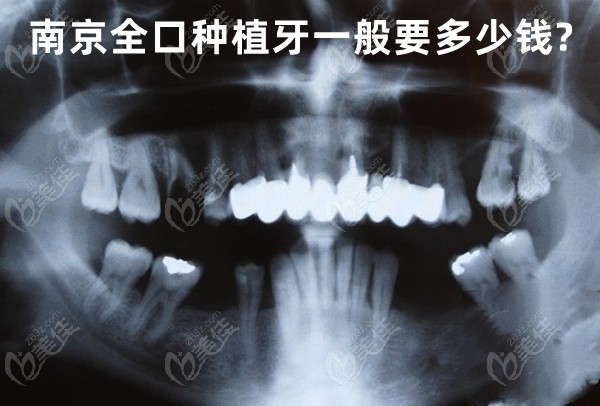 南京全口種植牙一般要多少錢
