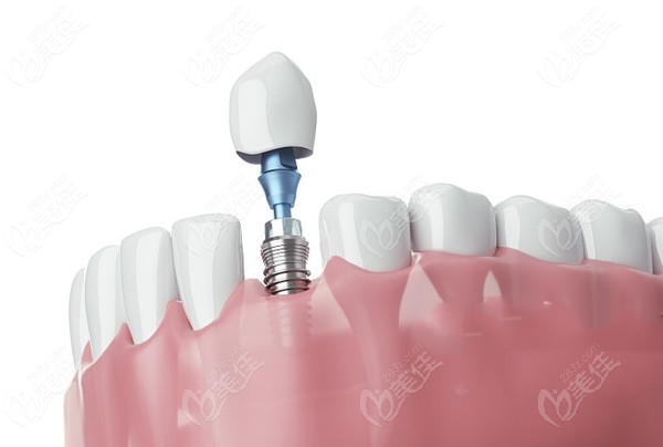 全口種植牙技術(shù)