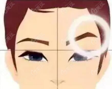 眉骨一边高一边低是什么原因造成的