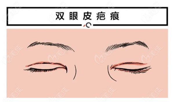 上海爱尚丽格杜园园医生修复双眼皮怎么样