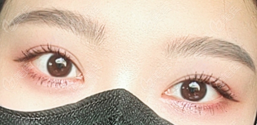 韩国ICON埋线双眼皮修复术后照片2