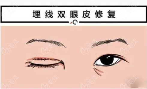 鄭州邵志明雙眼皮修復(fù)實(shí)例