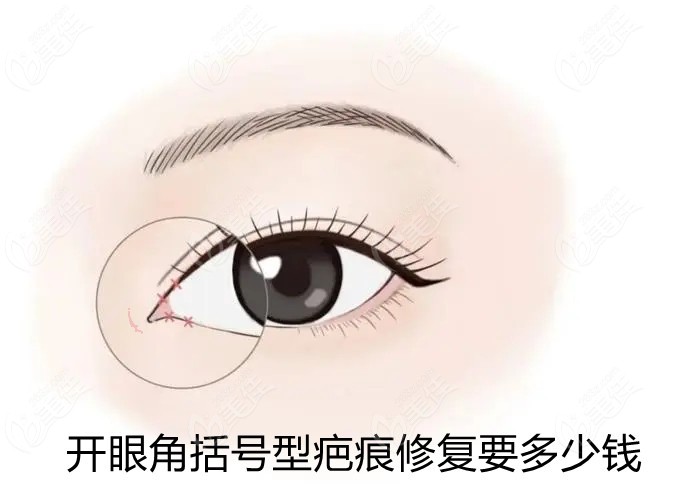 开眼角括号型疤痕修复要多少钱