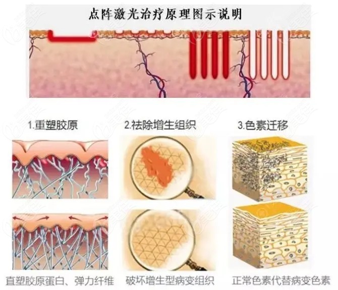 激光祛除眼角括号型凹陷疤痕