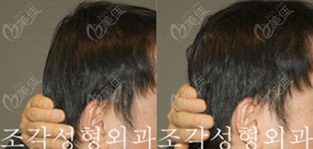 韩国雕刻医院后脑勺填充变圆头手术实例图